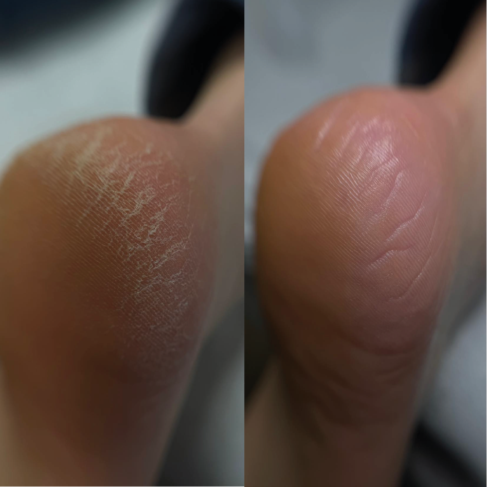 resultat formation soin anticallosité