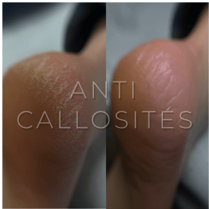 Formation Anti-callosités
